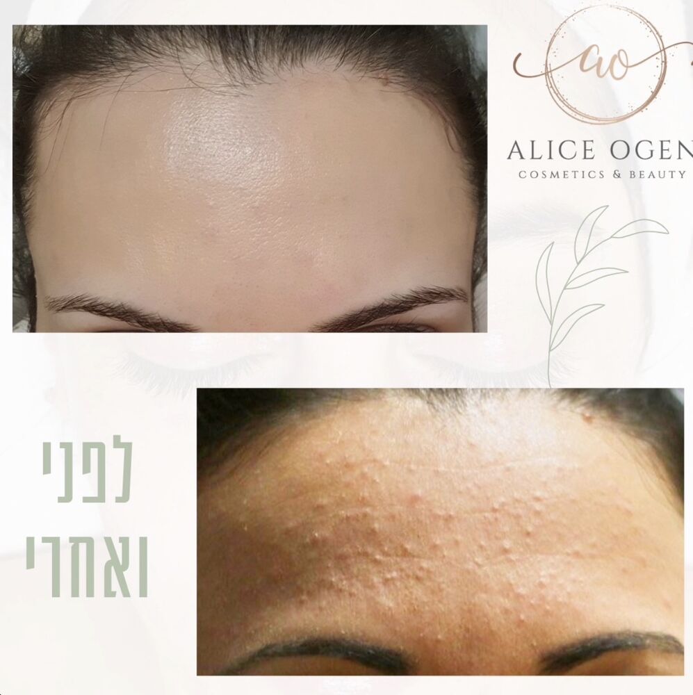 תוצאת טיפול לפני ואחרי בקליניקה של אליס עוגן, תמונה 8